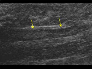 Thrombus filled calf vein longitudinal