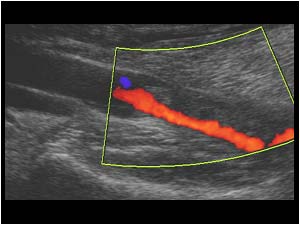 Thrombus extension in the distal popliteal vein longitudinal
