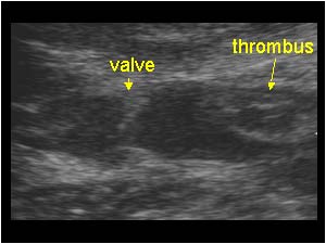 Thrombus extension in the distal popliteal vein longitudinal with valve just above the thrombus