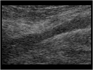 Thrombus in a vein on the dorsal side of the upper leg