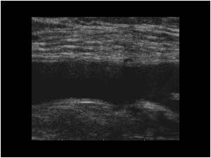Right common femoral vein during valsalva longitudinal