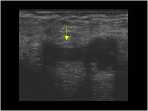 Left common femoral vein during valsalva transverse