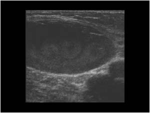 Dilated proximal greater saphenous vein
