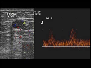 Vascularity in the vessel wall with an arterial doppler signal