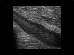 Dilatated axillary vein with slow flow