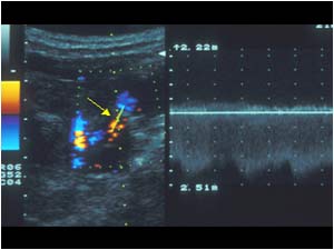 Stenosis with high velocity