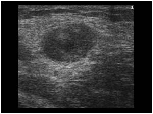 Thick walled thrombus filled superficial vein transverse