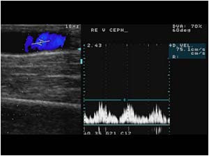 Normal signal before the stenosis