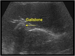 Gallstone and air in the intrahepatic bile ducts