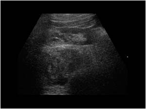 Large retroperitoneal hematoma causing displacement of the right kidney