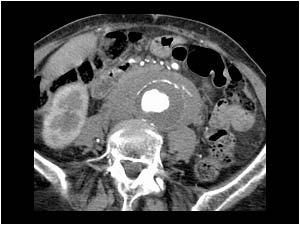 Inflammatory aortic aneurysm with a mass around the aneurysm causing dilatation of the right and left kidney