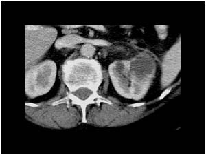 Complex renal cysts