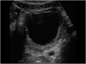 Thickened bladderwall and dilatated left ureter transverse