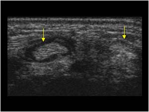 Extensor carpi radialis tendons transverse with synovial thickening of the extensor carpi radialis longus tendon