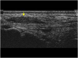 Synovial thickening at the distal insertion of the extensor carpi radialis longus tendon longitudinal