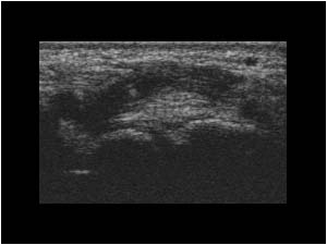 Synovial thickening at the distal insertion of the extensor carpi radialis longus tendon transverse