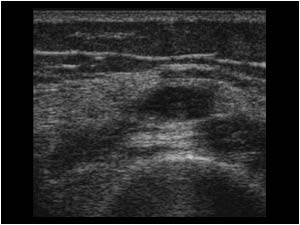 Cyst in the quadriceps transverse