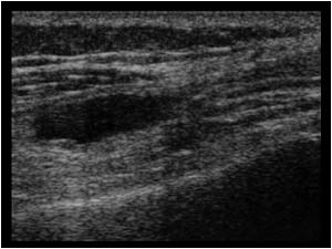 Cyst in the quadriceps longitudinal