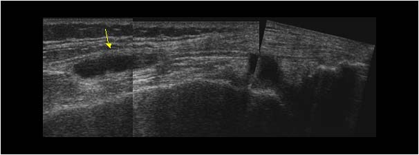 Cyst in the quadriceps longitudinal