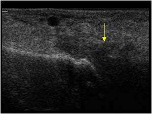 Arthritis of the metatarsophalangeal joint with synovial thickening