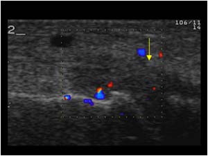 Arthritis of the metatarsophalangeal joint with synovial thickening