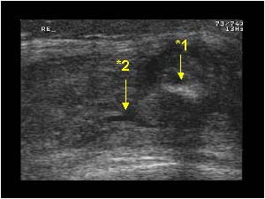 Exostosis transverse with quadriceps muscle rupture