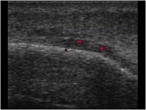 Periosteal thickening and hypervascularity transverse