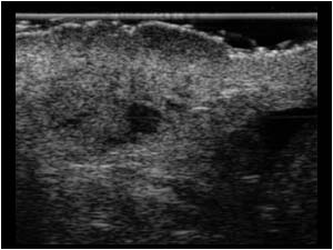 Subcutaneous lesion in the right groin
