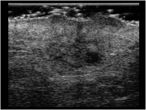 Subcutaneous lesion in the right groin