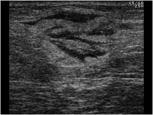 Subcutaneous lesion in the left upper leg