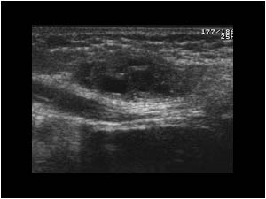 Inguinal hernia containing the left ovary