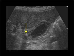Cholecystitis and obstructing stone in the gallbladderneck