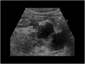 Ill defined cystic pancreatic masses and gastric wall infiltration