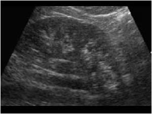 Medial projection of the lower pole of the right kidney