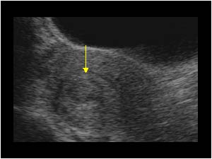 Submucosal fibroid with a hypoechoic mass transverse
