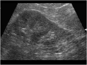 Medial projection of the lower pole of the left kidney
