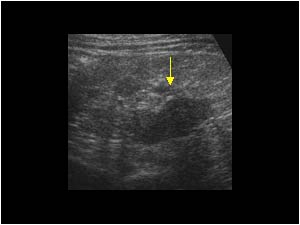 Renal scarring in the upper pole transverse