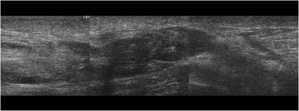 Distal biceps tendon rupture longitudinal