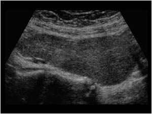 Pelvic kidney on the right side longitudinal