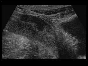 Pelvic kidney posterior to the bladder