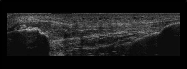 Longitudinal proximal patellar tendon with calcifications