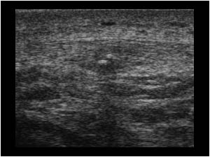 Transverse proximal patellar tendon with calcification