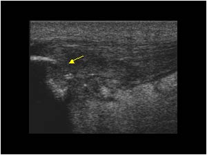 Apexitis and erosion of the lower pole of the patella