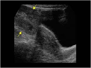 Pelvic kidney located cranial to the uterus