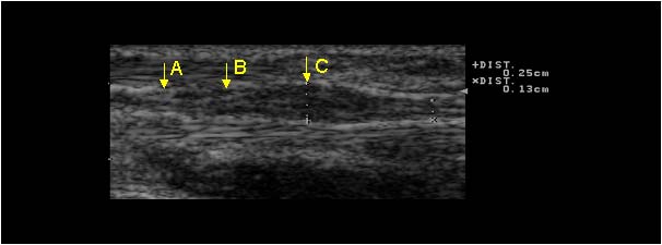 Posttraumatic thickening of the ulnar nerve longitudinal