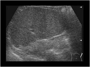 Spleen with no left kidney in the normal location