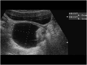 Cystic mass with peripheral nodules in the right ovary