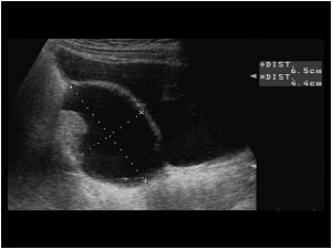 Cystic mass with peripheral nodules in the right ovary