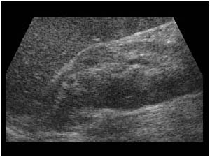 Pseudotumor caused by an abnormal rotation longitudinal
