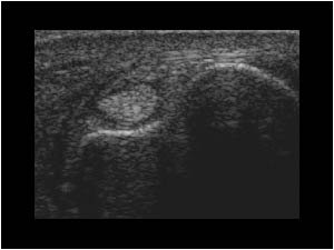 Tenosynovitis of the extensor carpi ulnaris tendon